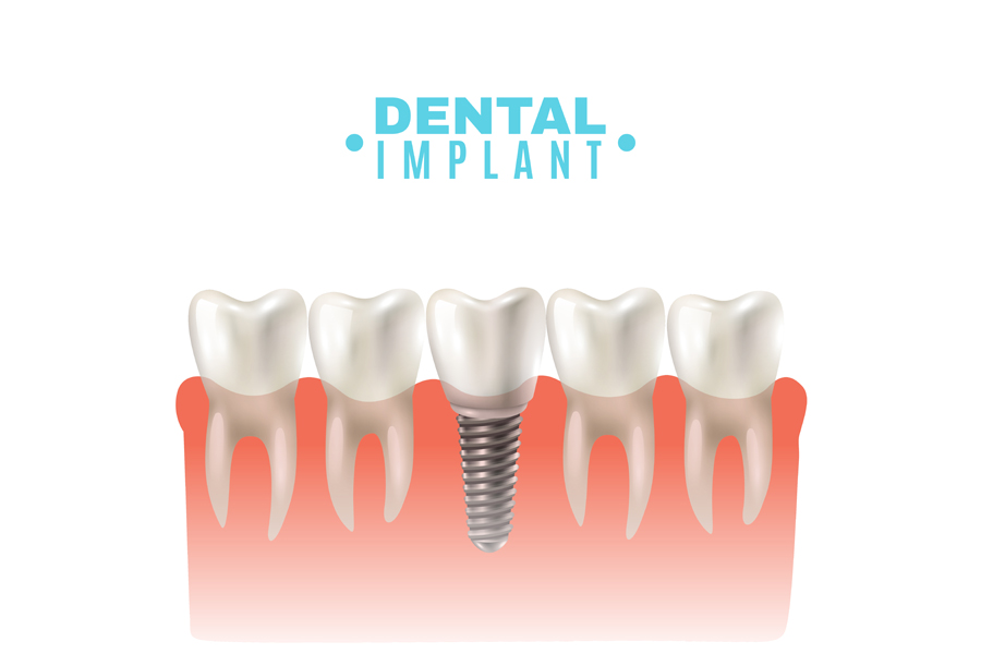 Dental Implant Model Side View Poster